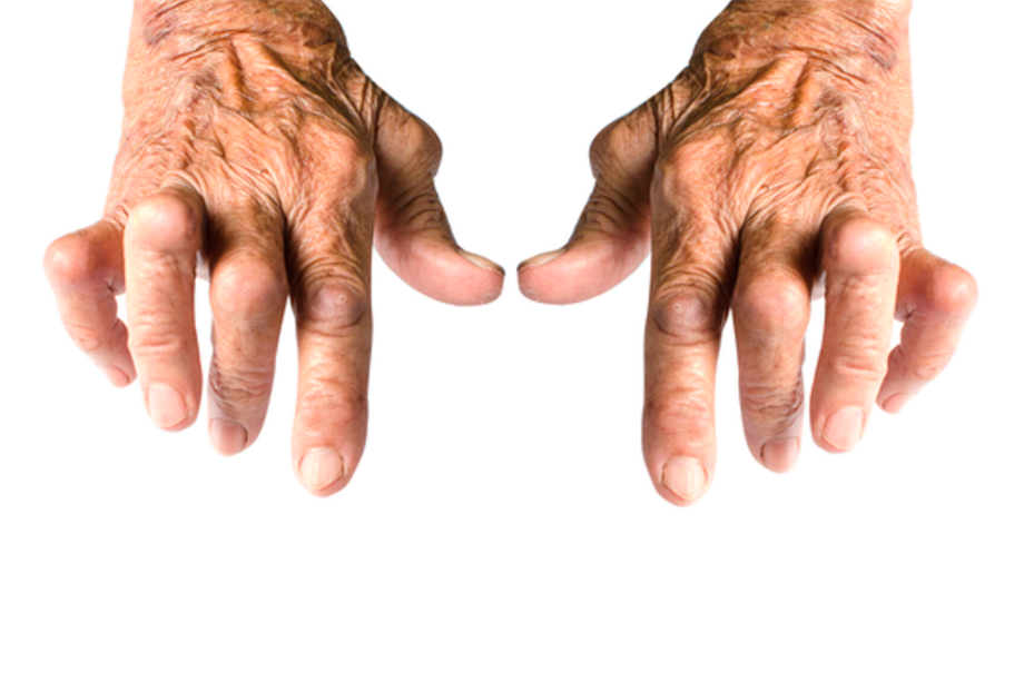 Artrite Reumatoide requer tratamento contínuo - Sociedade Mineira de  Reumatologia